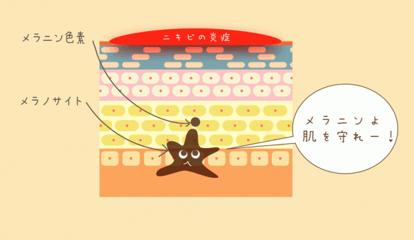 ニキビ跡のシミ 色素沈着を改善 短期間で消せるの サビーナウェルネスマガジン